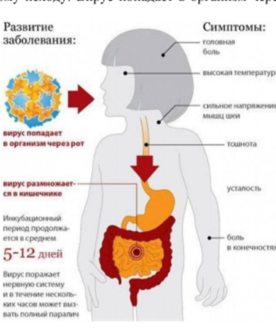Полиомиелит Полиомиелит.