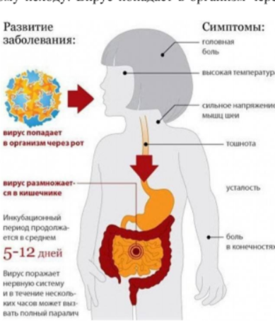 Полиомиелит.